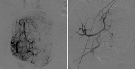 DSA介入治疗子宫肌瘤  ——取瘤保宫，给子宫重生的机会